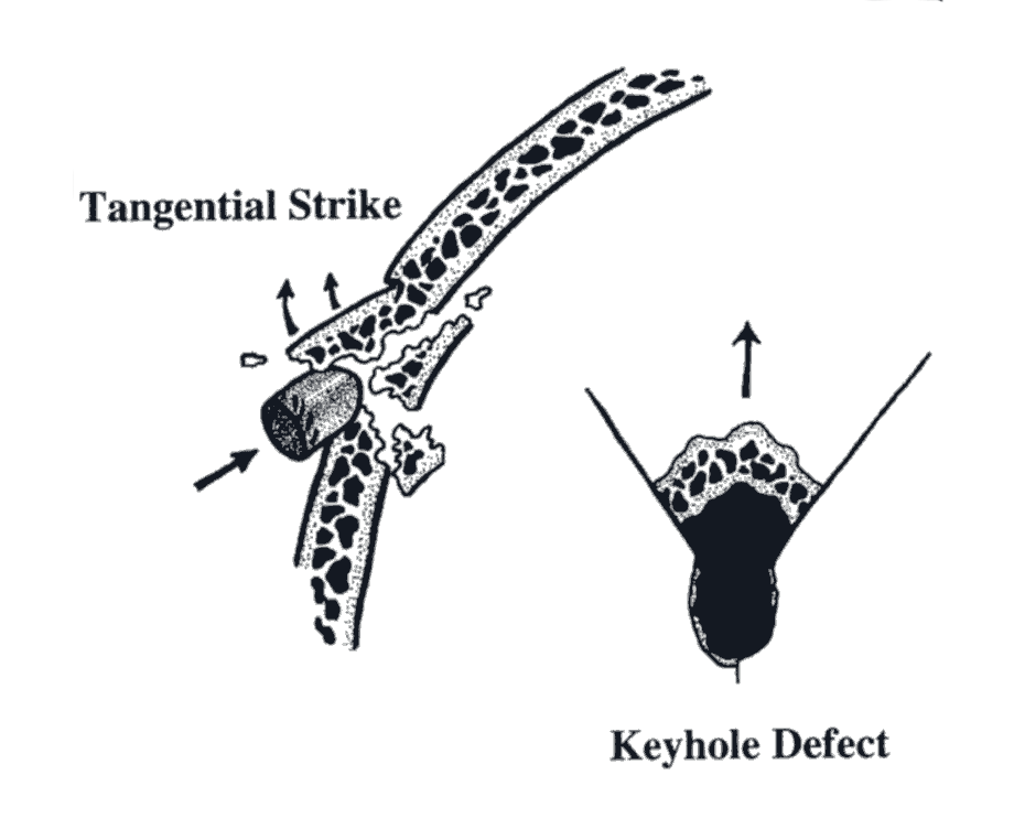 Damage to skull sustained by a tangential bullet strike.